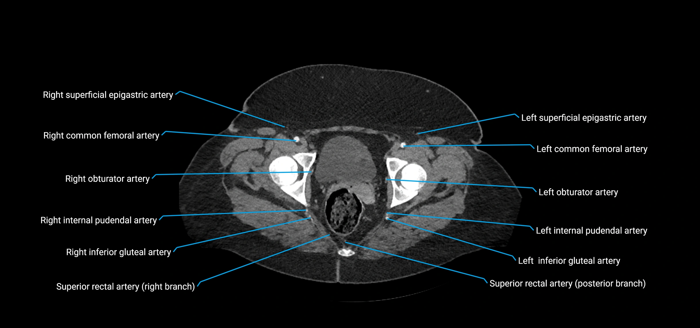 CTA abdomen axial cross sectional anatomy labelled image_243 (2).webp